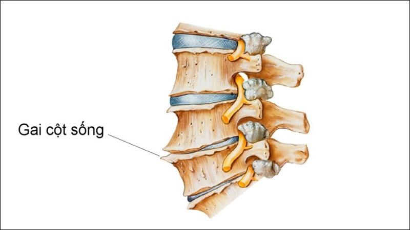 Gai xương khi đủ lớn có thể chèn ép tủy sống và rễ thần kinh