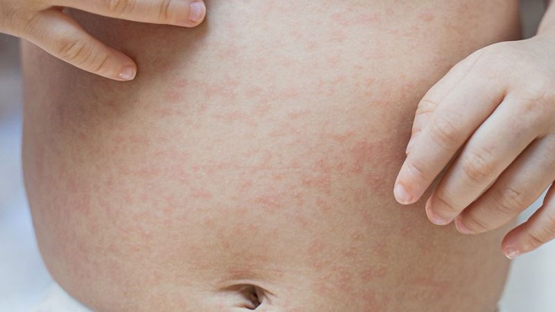 Phát ban khắp cơ thể ở giai đoạn khởi phát