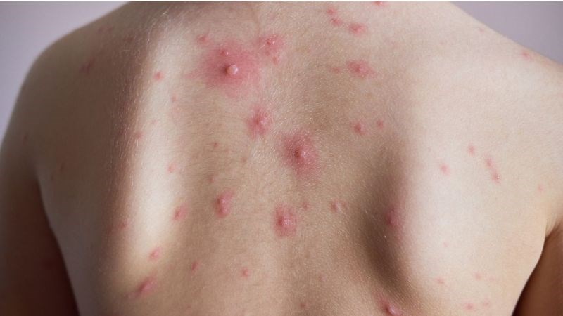 Xuất hiện các mụn nước gây ngứa