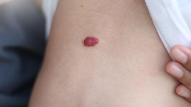 U máu là khối u màu đỏ xuất hiện trên da U máu là khối u màu đỏ xuất hiện trên da