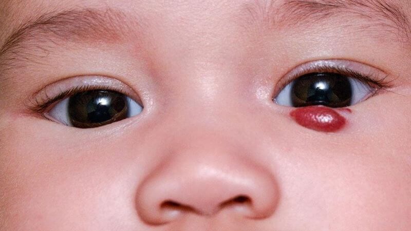 U máu ở mắt có thể ảnh hưởng đến thị lực U máu ở mắt có thể ảnh hưởng đến thị lực