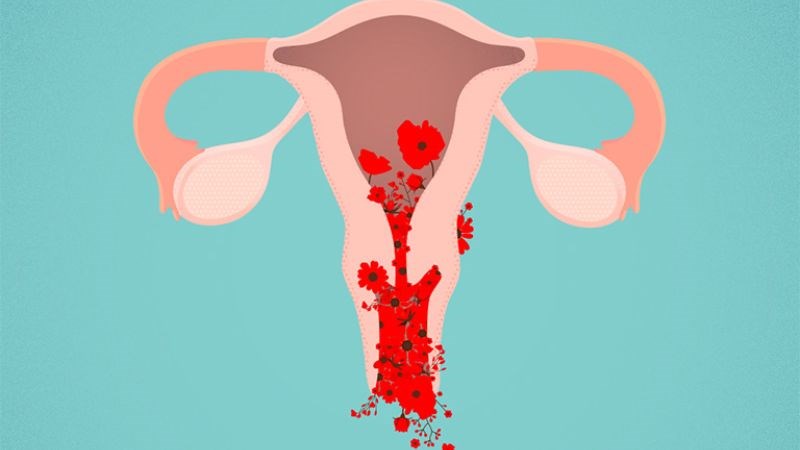 Chảy máu vùng kín bất thường là dấu hiệu sớm của ung thư cổ tử cung Chảy máu vùng kín bất thường là dấu hiệu sớm của ung thư cổ tử cung