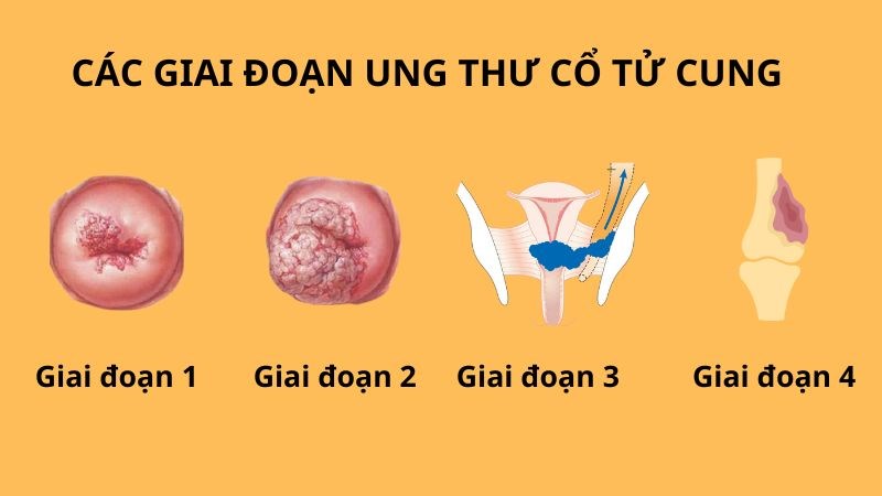 Ung thư cổ tử cung bao gồm 4 giai đoạn Ung thư cổ tử cung bao gồm 4 giai đoạn