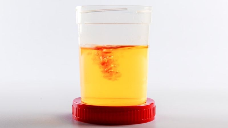 Tiểu máu là triệu chứng có thể gặp của ung thư cổ tử cung Tiểu máu là triệu chứng có thể gặp của ung thư cổ tử cung