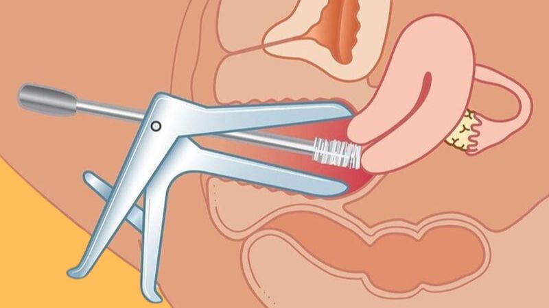 Soi cổ tử cung giúp bác sĩ quan sát khối u của người bệnh Soi cổ tử cung giúp bác sĩ quan sát khối u của người bệnh