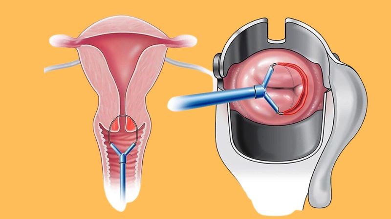 Sinh thiết giúp chẩn đoán bản chất tế bào khối u ở cổ tử cung Sinh thiết giúp chẩn đoán bản chất tế bào khối u ở cổ tử cung