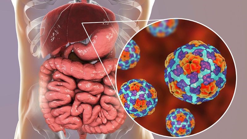 Viêm gan A là bệnh truyền nhiễm gây ra bởi virus viêm gan A (HAV) Viêm gan A là bệnh truyền nhiễm gây ra bởi virus viêm gan A (HAV)