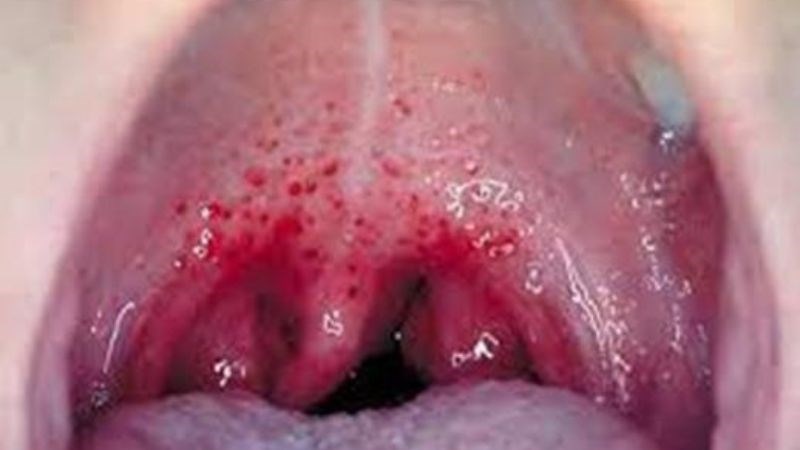 Amidan sưng đỏ là triệu chứng của viêm họng do liên cầu Amidan sưng đỏ là triệu chứng của viêm họng do liên cầu