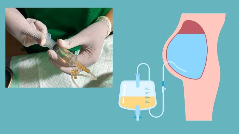 Chọc dịch cổ trướng là phương pháp giúp giảm dịch trong ổ bụng Chọc dịch cổ trướng là phương pháp giúp giảm dịch trong ổ bụng