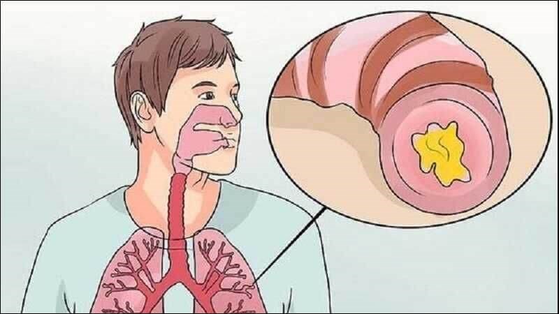 Xơ nang gây ho đờm kéo dài Xơ nang gây ho đờm kéo dài