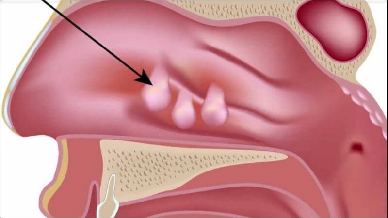 Xơ nang gây ra tình trạng polyp mũi tái phát nhiều lần Xơ nang gây ra tình trạng polyp mũi tái phát nhiều lần