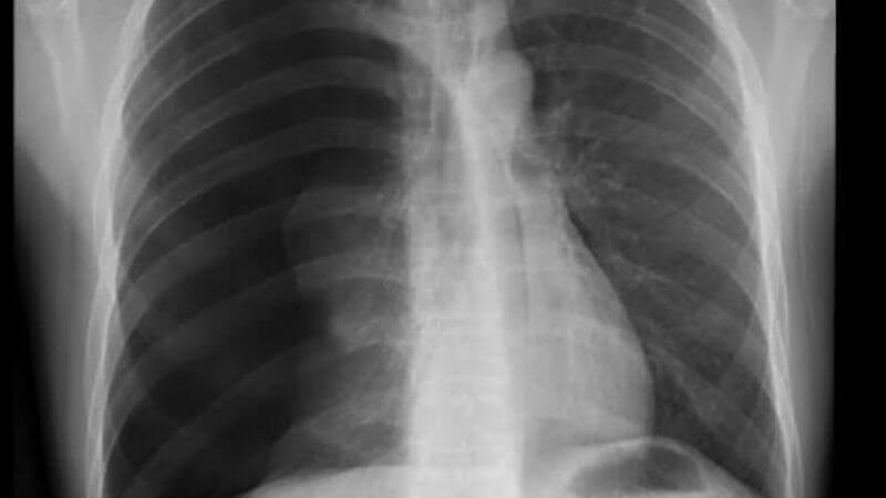 X-quang giúp xác định cấu trúc nang bất thường ở phổi X-quang giúp xác định cấu trúc nang bất thường ở phổi