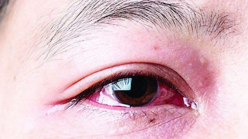 Dị ứng có thể làm xuất hiện tình trạng ngứa mắt