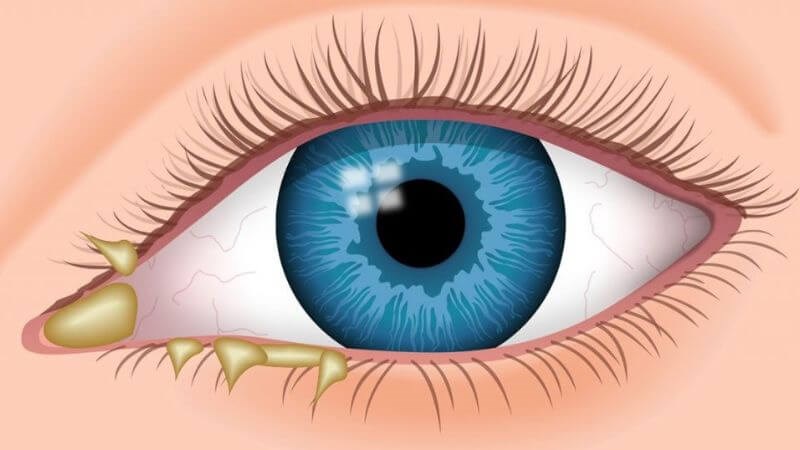 Khi xuất hiện dịch có màu bất thường tại mắt, người bệnh nên đến các cơ sở y tế để được tư vấn