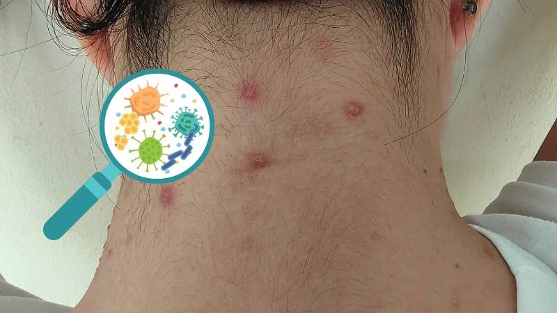 Nhiễm trùng da là tình trạng viêm nhiễm da do vi sinh vật gây ra