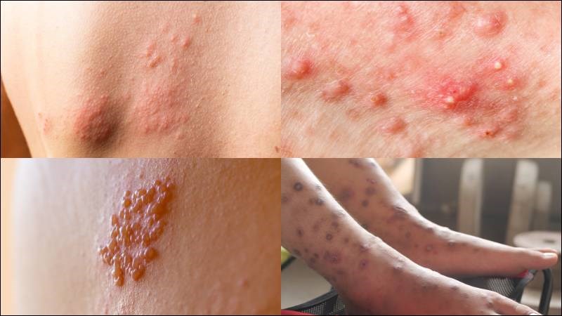 Các triệu chứng của nhiễm trùng da rất đa dạng