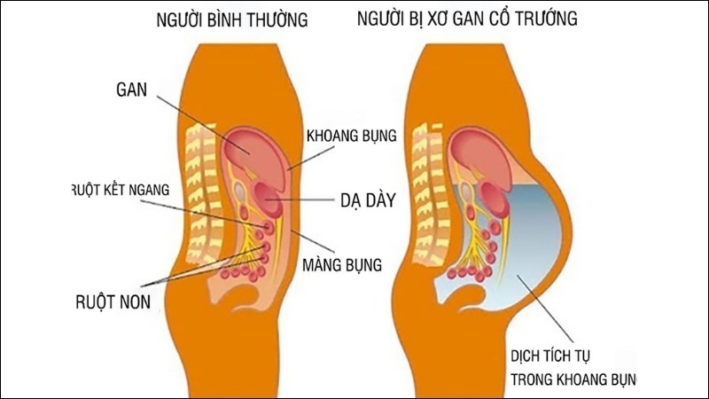 Cổ trướng là tình trạng khoang phúc mạc tích tụ lượng lớn dịch Cổ trướng là tình trạng khoang phúc mạc tích tụ lượng lớn dịch