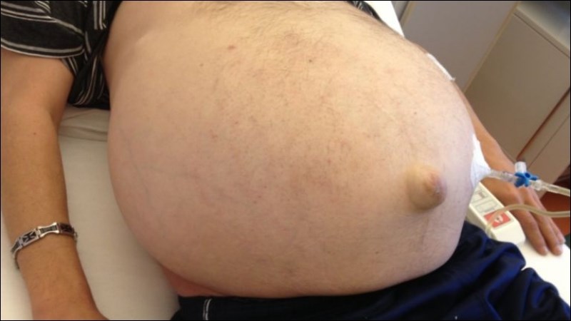 Bụng căng to, rốn lồi có thể là dấu hiệu của cổ trướng Bụng căng to, rốn lồi có thể là dấu hiệu của cổ trướng