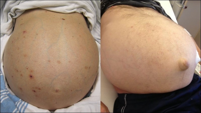 Cổ trướng có thể gây ra biến chứng thoát vị rốn Cổ trướng có thể gây ra biến chứng thoát vị rốn