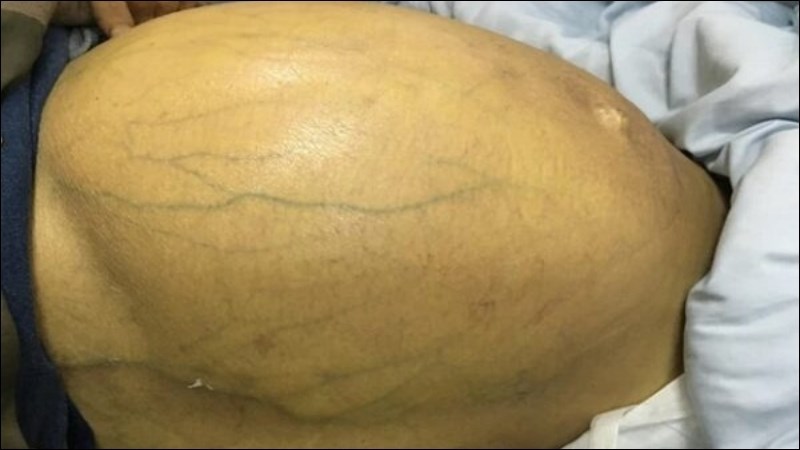 Bạn nên gặp bác sĩ nếu có dấu hiệu bụng căng to kèm khó thở khi nằm Bạn nên gặp bác sĩ nếu có dấu hiệu bụng căng to kèm khó thở khi nằm