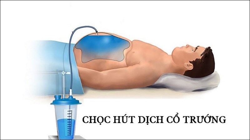 Chọc tháo dịch báng được chỉ định khi cổ trướng mức độ nặng Chọc tháo dịch báng được chỉ định khi cổ trướng mức độ nặng