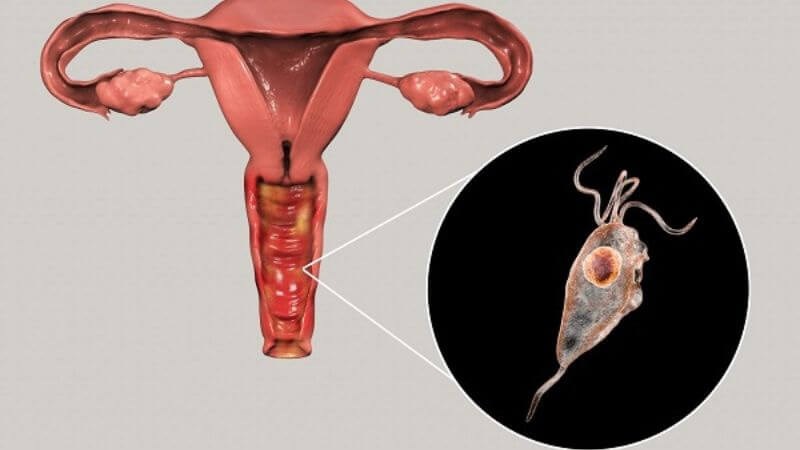 Nhiễm khuẩn âm đạo là sự mất cân bằng môi trường âm đạo