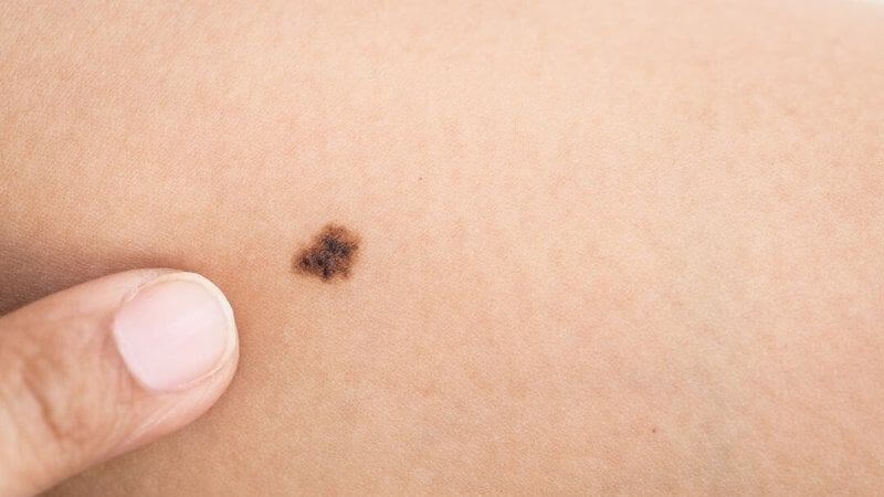 Ung thư biểu mô tế bào đáy có thể xuất hiện đốm đen Ung thư biểu mô tế bào đáy có thể xuất hiện đốm đen