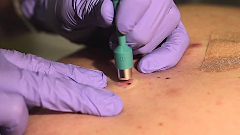 Sinh thiết da để chẩn đoán chính xác ung thư biểu mô tế bào đáy Sinh thiết da để chẩn đoán chính xác ung thư biểu mô tế bào đáy