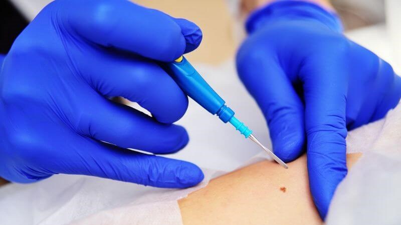 Phẫu thuật là phương pháp dùng để loại bỏ đốm đen trên da Phẫu thuật là phương pháp dùng để loại bỏ đốm đen trên da