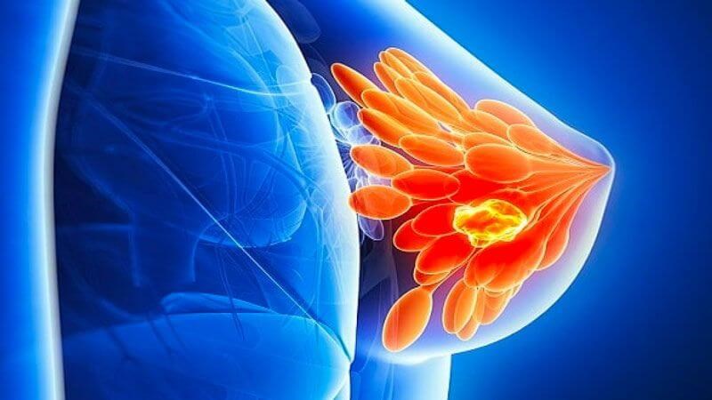 U nang vú là gì? Nguyên nhân, triệu chứng và cách điều trị