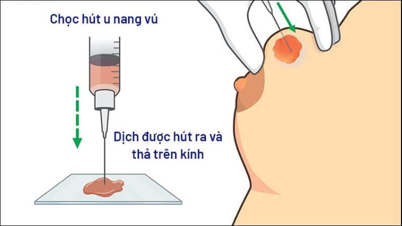Chọc hút dịch vừa có tác dụng điều trị cũng như chẩn đoán u nang vú Chọc hút dịch vừa có tác dụng điều trị cũng như chẩn đoán u nang vú