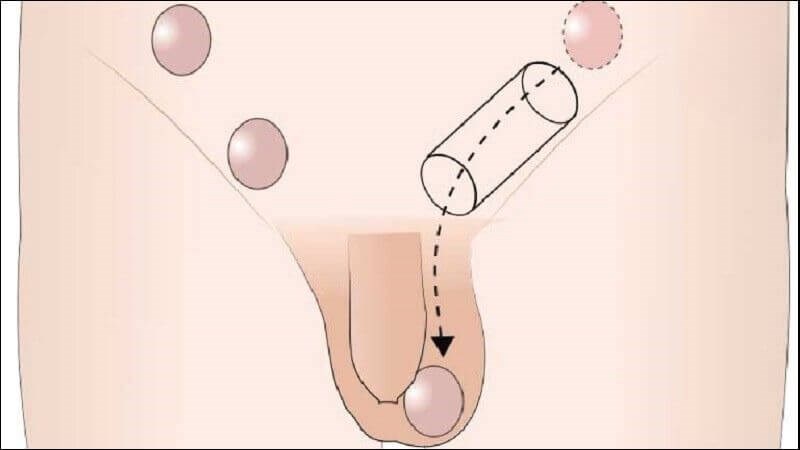 Tinh hoàn lạc chỗ là tình trạng tinh hoàn không có trong bìu Tinh hoàn lạc chỗ là tình trạng tinh hoàn không có trong bìu