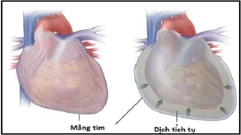 Hội chứng dressler là tình trạng viêm màng ngoài tim thứ phát Hội chứng dressler là tình trạng viêm màng ngoài tim thứ phát