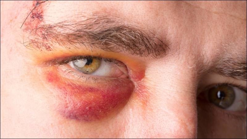 Mắt có thể sưng, đỏ, chảy máu sau chấn thương mắt