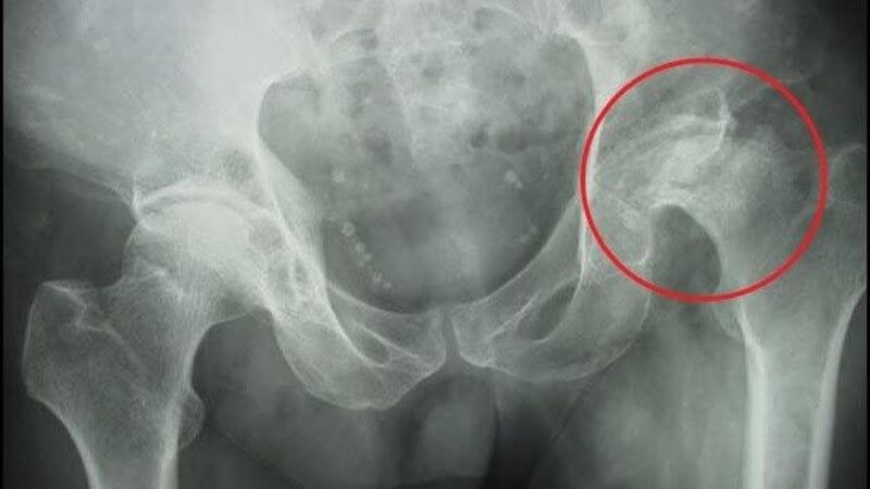 Chụp X-quang giúp chẩn đoán gãy xương đùi