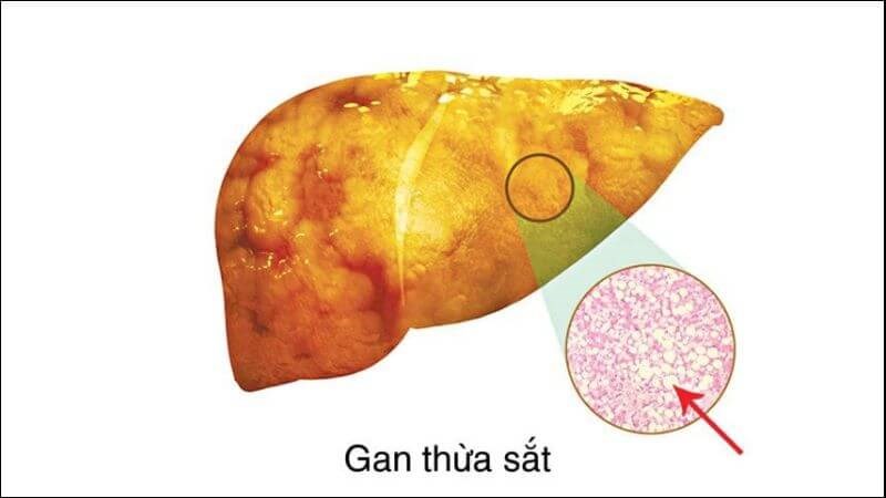 Tích trữ nhiều sắt có thể gây ra xơ gan