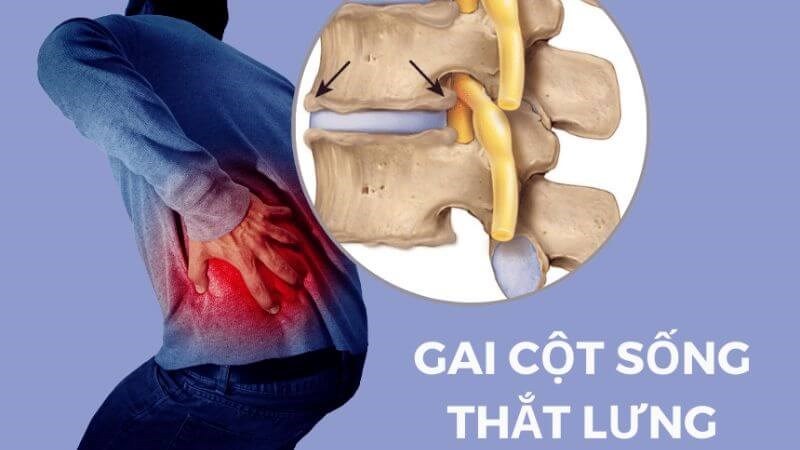 GAI CỘT SỐNG THẮT LƯNG: DẤU HIỆU, NGUYÊN NHÂN VÀ CÁCH ĐIỀU TRỊ – Bác Sĩ ...