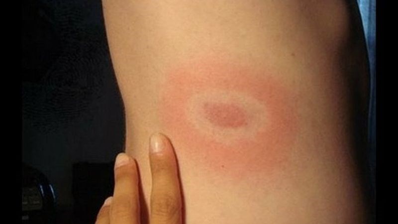 Phát ban hình tròn đơn lẻ là triệu chứng thường gặp của bệnh Lyme