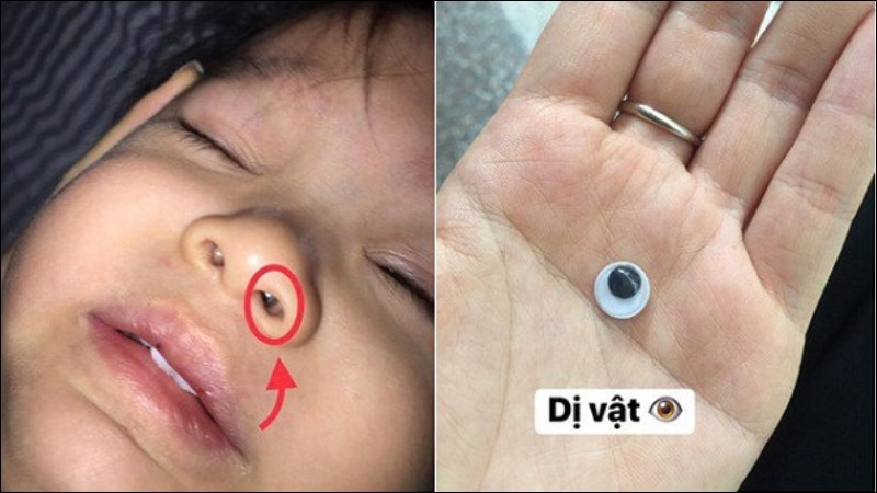 Dị vật trong mũi là trường hợp cấp cứu phổ biến ở trẻ em dưới 5 tuổi Dị vật trong mũi là trường hợp cấp cứu phổ biến ở trẻ em dưới 5 tuổi
