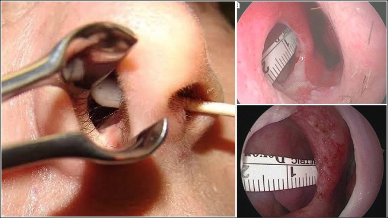 Dị vật trong mũi có thể gây biến chứng thủng vách ngăn mũi Dị vật trong mũi có thể gây biến chứng thủng vách ngăn mũi