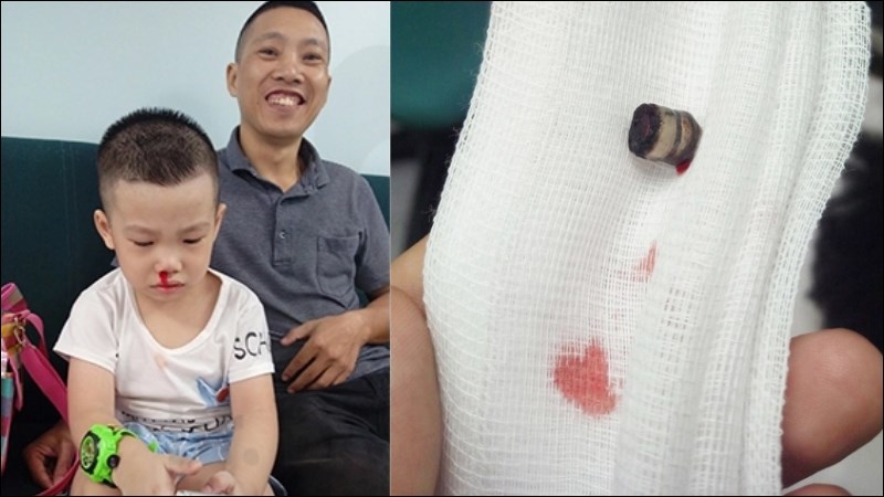 Người nhà cần cho trẻ tới gặp bác sĩ ngay nếu nghi ngờ dị vật mũi là pin Người nhà cần cho trẻ tới gặp bác sĩ ngay nếu nghi ngờ dị vật mũi là pin