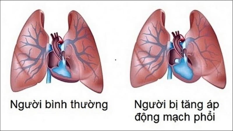 Tăng huyết áp động mạch phổi đặc trưng bởi huyết áp cao trong các động mạch phổi Tăng huyết áp động mạch phổi đặc trưng bởi huyết áp cao trong các động mạch phổi