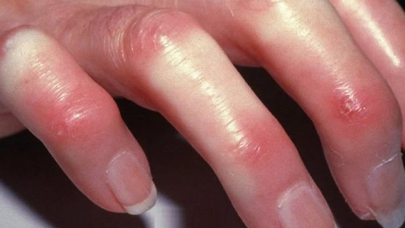 Xơ cứng bì là một trong những yếu tố nguy cơ của bệnh tăng áp động mạch phổi Xơ cứng bì là một trong những yếu tố nguy cơ của bệnh tăng áp động mạch phổi