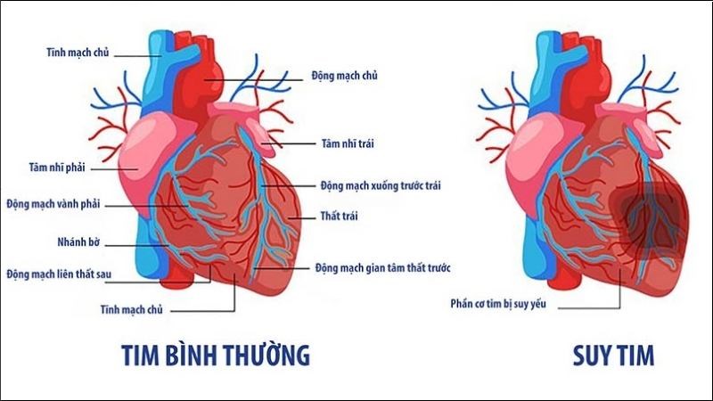 Suy tim là một biến chứng của tăng áp động mạch phổi Suy tim là một biến chứng của tăng áp động mạch phổi