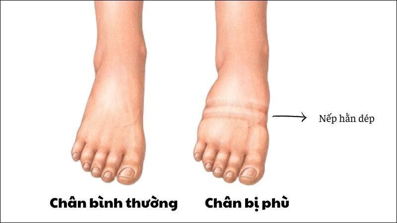 Phù chân là một trong những dấu hiệu cần đến gặp bác sĩ nếu nghi ngờ tăng áp động mạch phổi Phù chân là một trong những dấu hiệu cần đến gặp bác sĩ nếu nghi ngờ tăng áp động mạch phổi