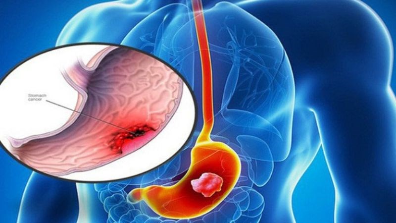 Viêm dạ dày có thể dẫn tới thiếu vitamin B12