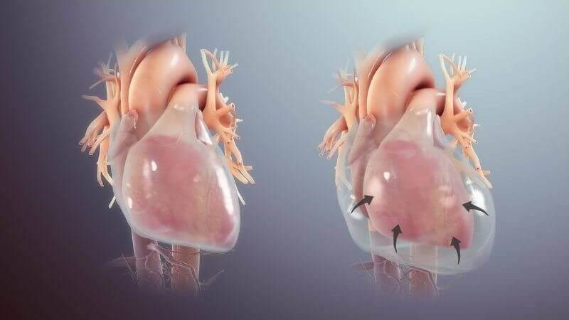Ghẻ cóc có thể gây biến chứng viêm màng ngoài tim Ghẻ cóc có thể gây biến chứng viêm màng ngoài tim