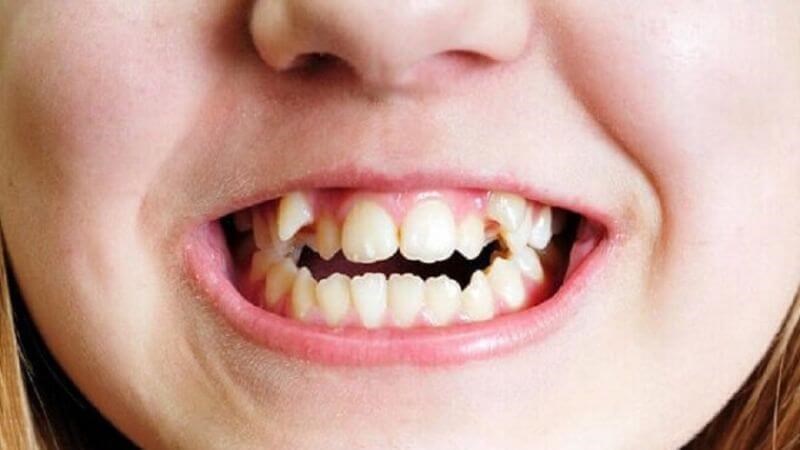 Răng thừa là tình trạng răng mọc bất thường trên khuôn hàm