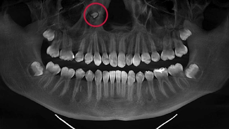 Răng hình nón là nhóm răng thừa hay gặp