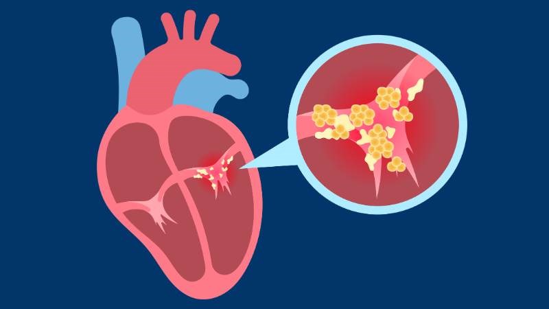 Viêm nội tâm mạc nhiễm khuẩn bán cấp hiếm gây tổn thương tim nghiêm trọng